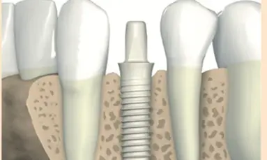 Use of aluminium alloy for biomedical implants
