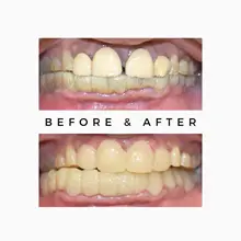 Before After 12