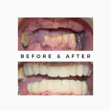 Before After 13