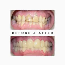 Before After 14