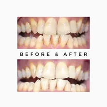 Before After 7