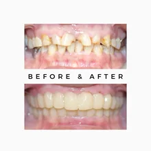 Before After 9
