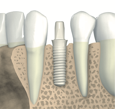 Metal Free Dental Implants – Rule 1